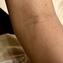 United Community Health Center - Bruise from botched blood draw on my teen daughter.
