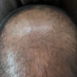 Hair Restoration Specialists of Atlanta