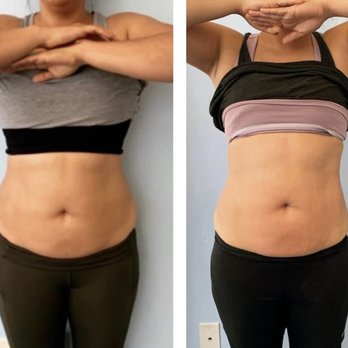 CryoBahr - After 4 sessions - Cryotherapy Near Me