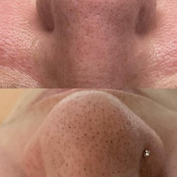 Pretty Zen Studio - Nose Extractions Before and After. - Skin Care Near Me - Rancho Cucamonga, California Pretty Zen Studio - Nose Extractions Before and After. - Skin Care Near Me - Rancho Cucamonga, California