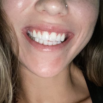 Naturally White Teeth Whitening - 6 hours later - Teeth Whitening Near Me - Houston, Texas Naturally White Teeth Whitening - 6 hours later - Teeth Whitening Near Me - Houston, Texas