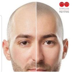 Scalp Hairlines International - From bald to bold