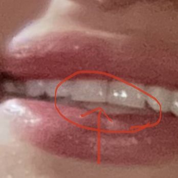 Oakmead Dental - My teeth before i came to the dentist. - General Dentistry Near Me - Sunnyvale, California Oakmead Dental - My teeth before i came to the dentist. - General Dentistry Near Me - Sunnyvale, California