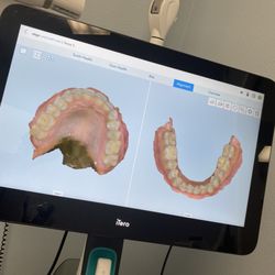 Oasis Dental Care - Teeth scan. They put a bar in your mouth and scan everything so the dentist can show you what he's taking about in RT.