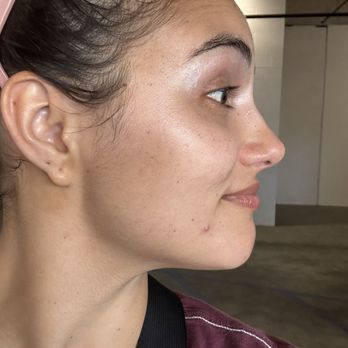 Skin Energy - Post facial glow side profile 2 - Skin Care Near Me - San Diego, California Skin Energy - Post facial glow side profile 2 - Skin Care Near Me - San Diego, California