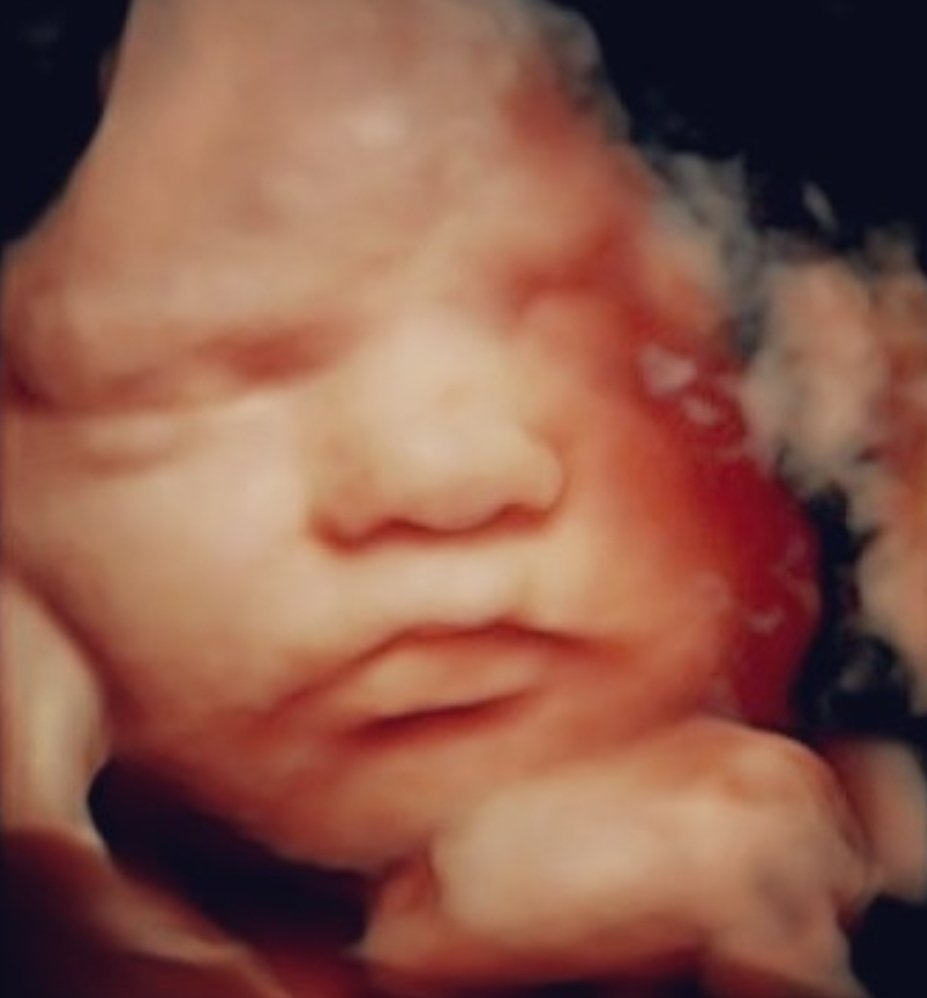 Miracle View 3D/4D Ultrasound