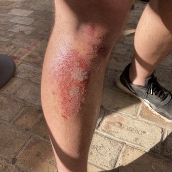Maui Mountain Cruisers - 2 day old road rash. Again, tour guide said this was "a little scrape" - Bikes Near Me Maui Mountain Cruisers - 2 day old road rash. Again, tour guide said this was "a little scrape" - Bikes Near Me