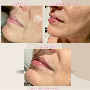 Skin Lab by Inga RN - Lippies - Juvederm Volbella - Medical Spas Near Me - Johns Creek, Georgia Skin Lab by Inga RN - Lippies - Juvederm Volbella - Medical Spas Near Me - Johns Creek, Georgia