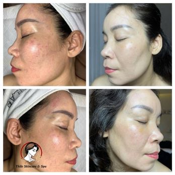 Thile Skincare - facial services, massage therapy near me, skincare treatments - Skin Care Near Me - Duluth, Georgia Thile Skincare - facial services, massage therapy near me, skincare treatments - Skin Care Near Me - Duluth, Georgia