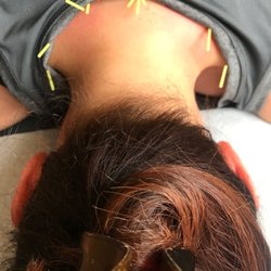 Greenwich Sports Medicine - Acupuncture