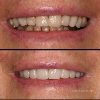 Harmony Dentistry - Our porcelain veneers done by Dr. Ash :) - Cosmetic Dentists Near Me - Mission Viejo, California Harmony Dentistry - Our porcelain veneers done by Dr. Ash :) - Cosmetic Dentists Near Me - Mission Viejo, California