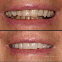 Harmony Dentistry - Our porcelain veneers done by Dr. Ash :)