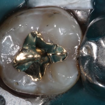 Michael S Capio, DDS - Dental Solutions - Gold inlay - General Dentistry Near Me - Los Angeles, California Michael S Capio, DDS - Dental Solutions - Gold inlay - General Dentistry Near Me - Los Angeles, California