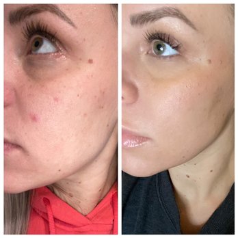 Rose Esthetics - Results!! - Skin Care Near Me - Grass Valley, California