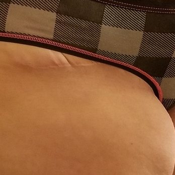Amelia Aesthetics - Scar very low, sits below any panty line - Medical Spas Near Me - Raleigh, North Carolina Amelia Aesthetics - Scar very low, sits below any panty line - Medical Spas Near Me - Raleigh, North Carolina