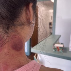 Oahu Central Earth Acupuncture & Chinese Medicine Clinic - Cupping and guasha