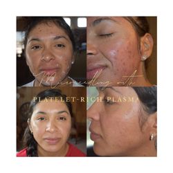 Exclusively Glamorous - Microneedling with PLatelet-Rich Plasma
