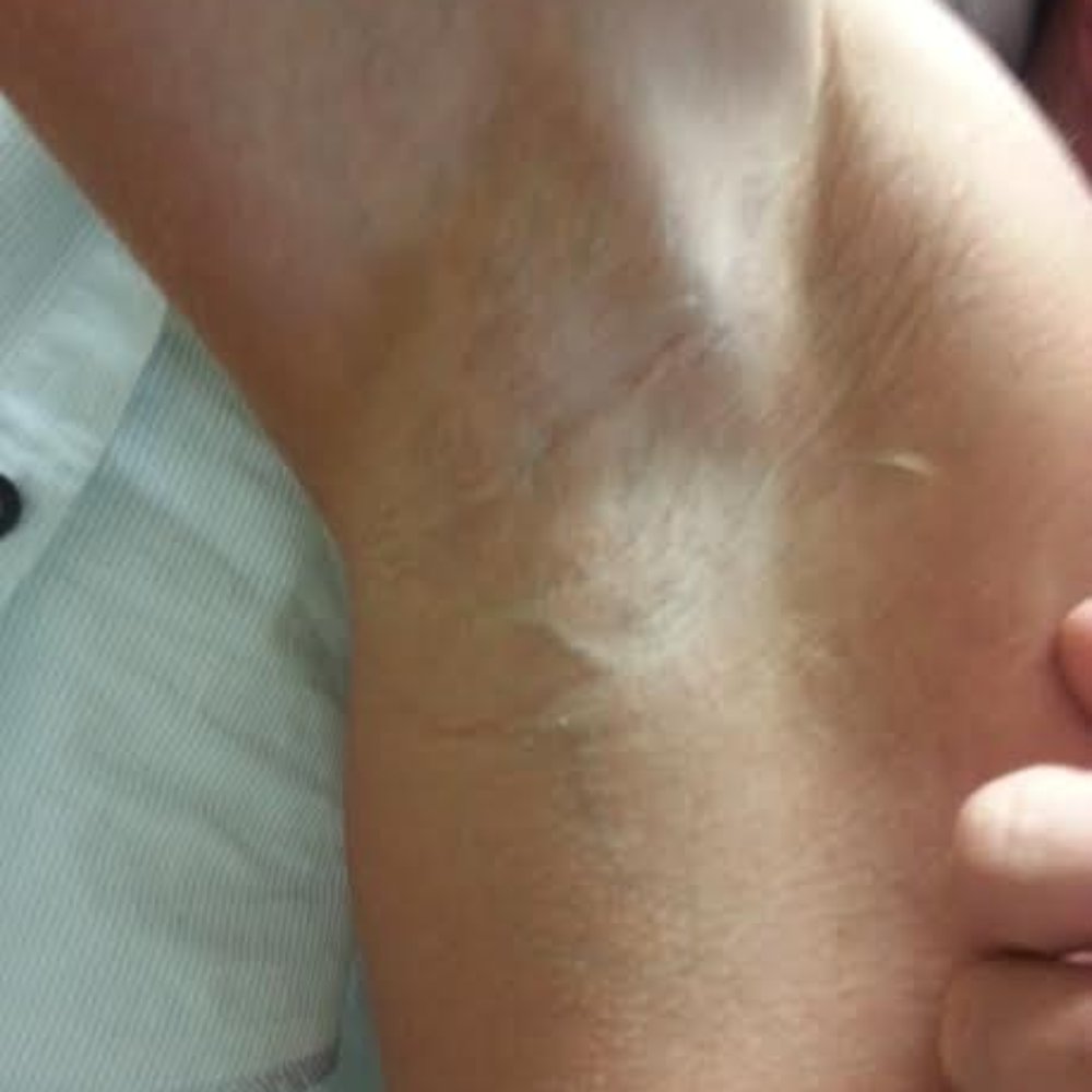 NEOS Med Spa - Men can reduce under arm hair too - Laser Hair Removal Near Me - Tempe, Arizona