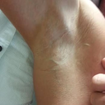 NEOS Med Spa - Men can reduce under arm hair too - Laser Hair Removal Near Me - Tempe, Arizona