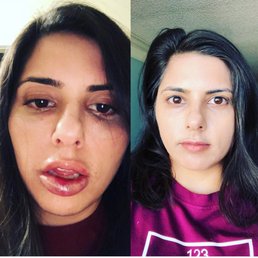 Aesthetic Lane on left, board certified dermatologist on right. Both taken day of treatment. Aesthetic Lane on left, board certified dermatologist on right. Both taken day of treatment.