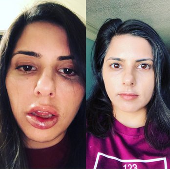 Aesthetic Lane - Aesthetic Lane on left, board certified dermatologist on right. Both taken day of treatment. - Medical Spas Near Me - Winter Park, Florida Aesthetic Lane - Aesthetic Lane on left, board certified dermatologist on right. Both taken day of treatment. - Medical Spas Near Me - Winter Park, Florida