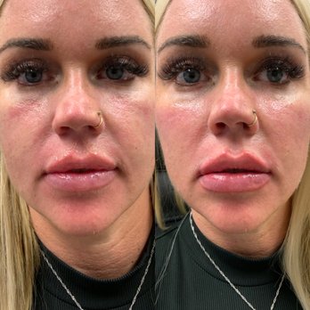 Flawless Med Spa - Before and After cheek and lip filler - Medical Spas Near Me - Bryant, Arkansas