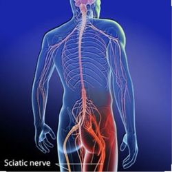 Hijama & Cupping Therapy - Sciatica can be treated with Cupping.