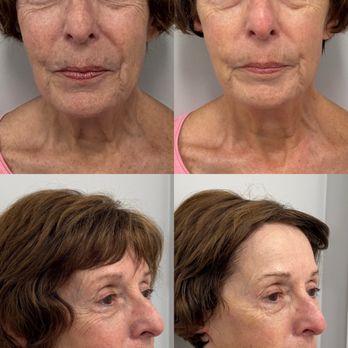 BioLift Med Spa - Facelift Rescue promotion $97 - Acne Treatment Near Me - Boynton Beach, Florida BioLift Med Spa - Facelift Rescue promotion $97 - Acne Treatment Near Me - Boynton Beach, Florida