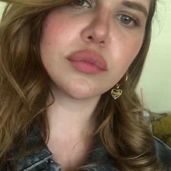 Michael H Robbins, DDS - THIS was my face 48 hours before I went to see Dr Robbins. I remember taking this selfie because I was having a good hair day. - Cosmetic Dentists Near Me - Beverly Hills, California