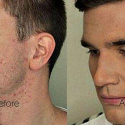 Avalon Medical Spa - Photodynamic Therapy for Acne 1 Treatments