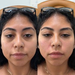 Glamour By Gaby - EZ Gel PRF Undereyes & smile lines before and after
