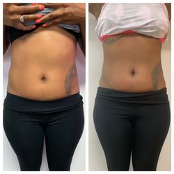 Ynobe Beauty Lounge - Progress photos of laser Lipo + Lipo Cavitation sessions