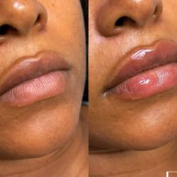 River Oaks MedSpa - Lip filler before and after