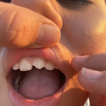 Madison Square Dentistry - Broken front tooth - Cosmetic Dentists Near Me - Murrieta, California