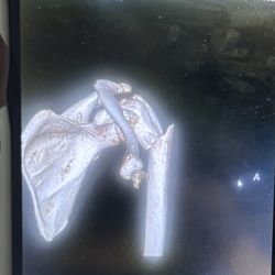 OrthoConnecticut - Danbury - Broken humerus NOT funny