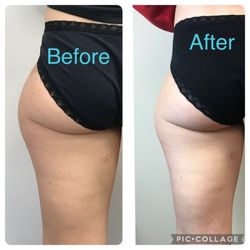 CryoSculpt - Treatment on side of hip.
