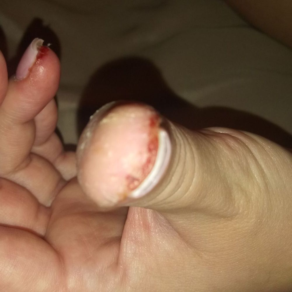 Herbal Nails & Spa In Mesa-Gilbert - THUMB NAIL WHICH WAS OVER FILED.... WHICH LET TO MY NAIL BEING RAW AND ON FIRE!  THIS WAS PROBABLY 2 DAYS AFTER GETTING NAILS ON! - Nail Salons Near Me - Gilbert, Arizona