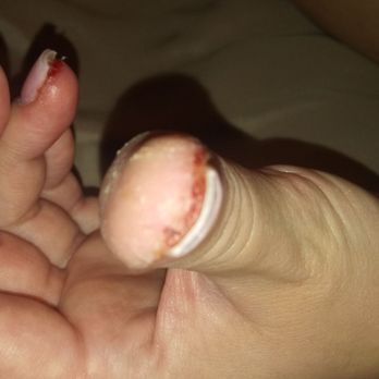 Herbal Nails & Spa In Mesa-Gilbert - THUMB NAIL WHICH WAS OVER FILED.... WHICH LET TO MY NAIL BEING RAW AND ON FIRE!  THIS WAS PROBABLY 2 DAYS AFTER GETTING NAILS ON! - Nail Salons Near Me - Gilbert, Arizona