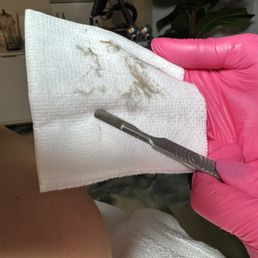 Post Dermaplane. yuck. Post Dermaplane. yuck.