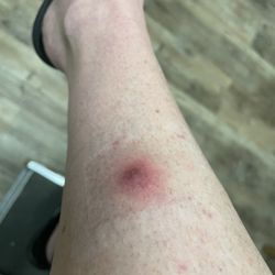Happy Nails & Spa - Staph infection = 10 days of antibiotics