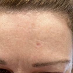 Forefront Dermatology Glendale, WI - Hole in my forehead!