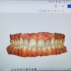 Diagonal Dental of Boulder - Digital impressions by Dr. Brett Amedro, DDS