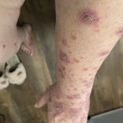 Banner MD Anderson Cancer Center - The rash that spread to the patients arms.