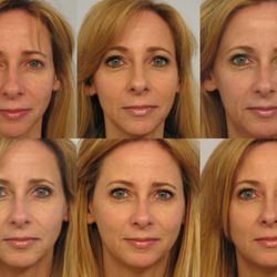 Michael A. Persky, M.D, F.A.C.S - SCULPTRA