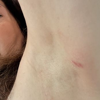 LaserAway - A burn the evening after treatment - Tattoo Removal Near Me - New York, New York LaserAway - A burn the evening after treatment - Tattoo Removal Near Me - New York, New York