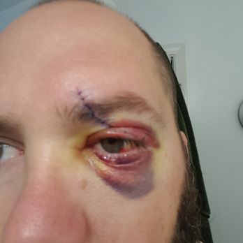 San Diego Eyelid Specialists - Stitched up later that day - Cosmetic Surgeons Near Me - Encinitas, California