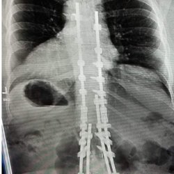 Advanced Spine and Pain - I am fused from C3-C7 and T4-S1. Todd knew NOTHING of my case! I had to explain t to him before he abruptly dismissed me.