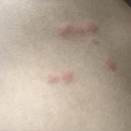 Bed Bug Bites After Sleeping at this hotel