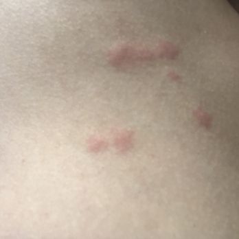 La Quinta Inn & Suites Cedar Rapids - Bed Bug Bites After Sleeping at this hotel - Hotels Near Me - Cedar Rapids, Iowa
