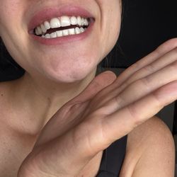 NYC Smile Spa - Crowns